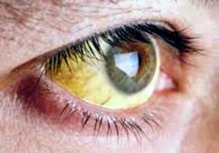 Mutirão na Policlínica contra a febre amarela vacina mais de 500 pessoas no sábado