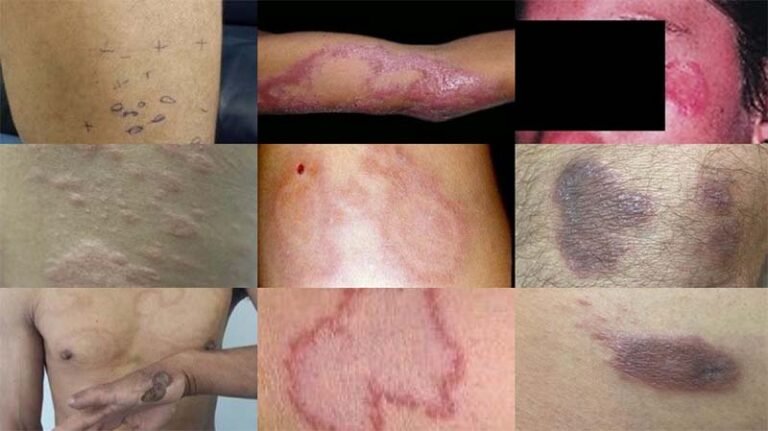 Brasil é o segundo país com mais casos de hanseníase e especialista alerta sobre sintomas 